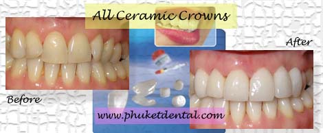 All ceramic crowns&bridges
